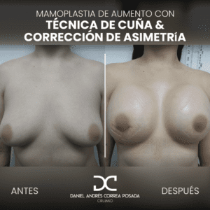 AYD MAMOPLASTIA-36