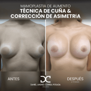 AYD MAMOPLASTIA-37