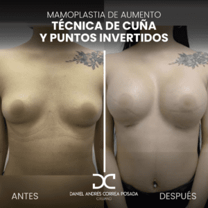 AYD MAMOPLASTIA-38