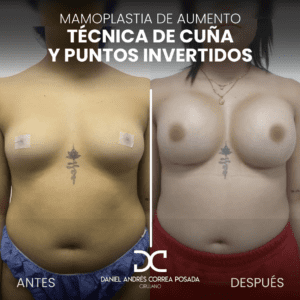 AYD MAMOPLASTIA-40