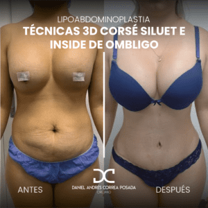 AYD LIPOABDOMINO-28-28