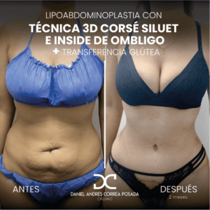 AYD LIPOABDOMINO-28-30
