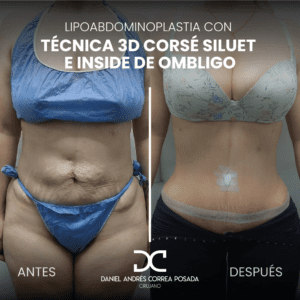 AYD LIPOABDOMINO-28-32