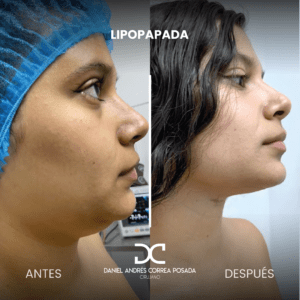 LIPOPAPADA