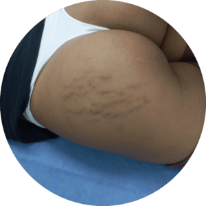 Corrección de cicatriz antes