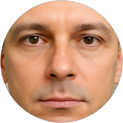 Blefaroplastia Inferior