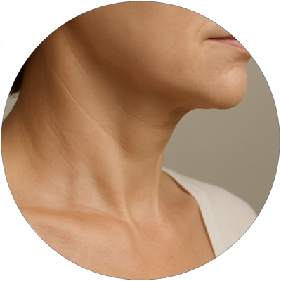 Mini Lifting de cuello