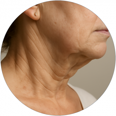 Mini Lifting de cuello